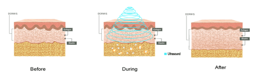 Cavitation_graphic